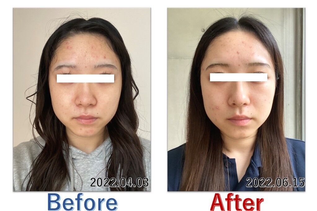 基礎化粧品を使用したBefore＆After