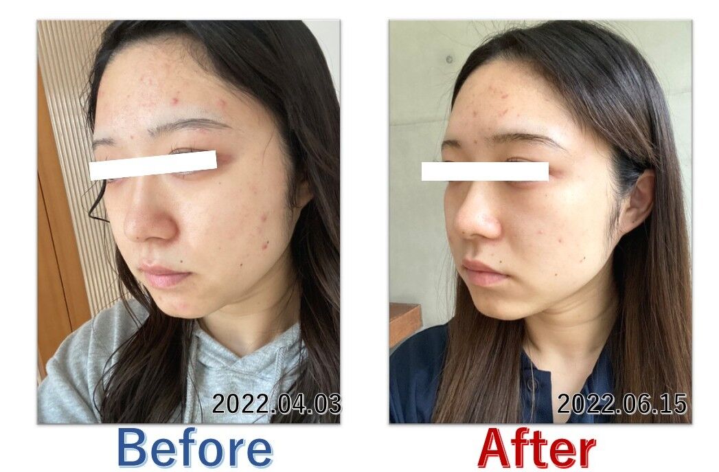 基礎化粧品を使用したBefore＆After