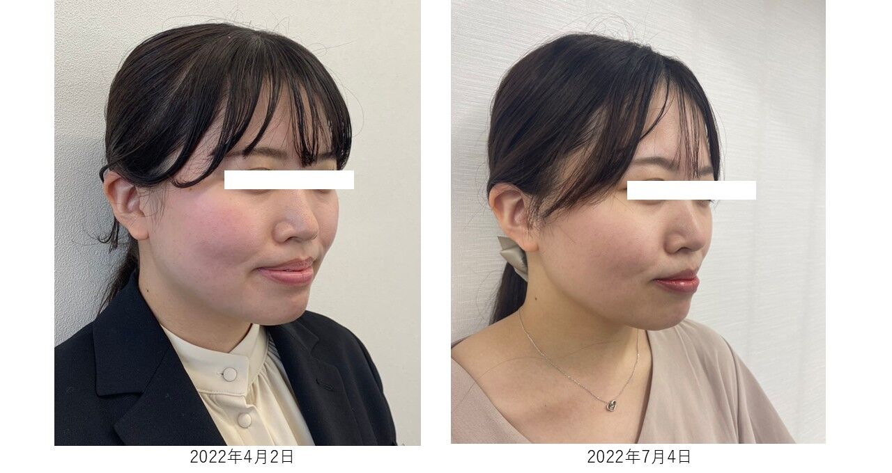 基礎化粧品を使用したBefore＆After