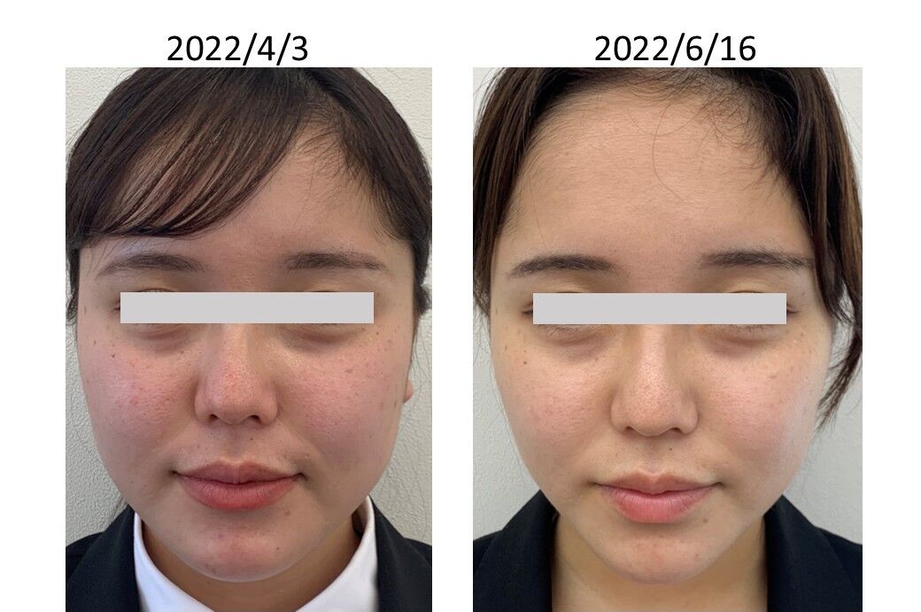 基礎化粧品を使用したBefore＆After