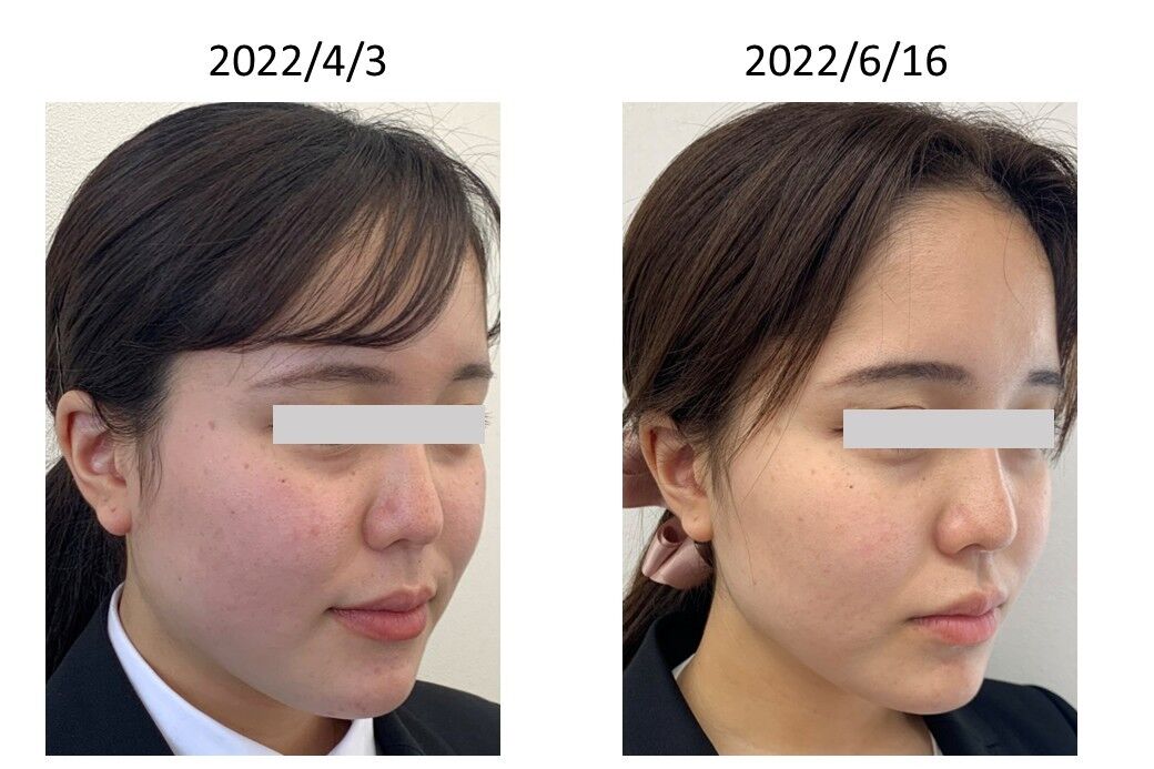 基礎化粧品を使用したBefore＆After